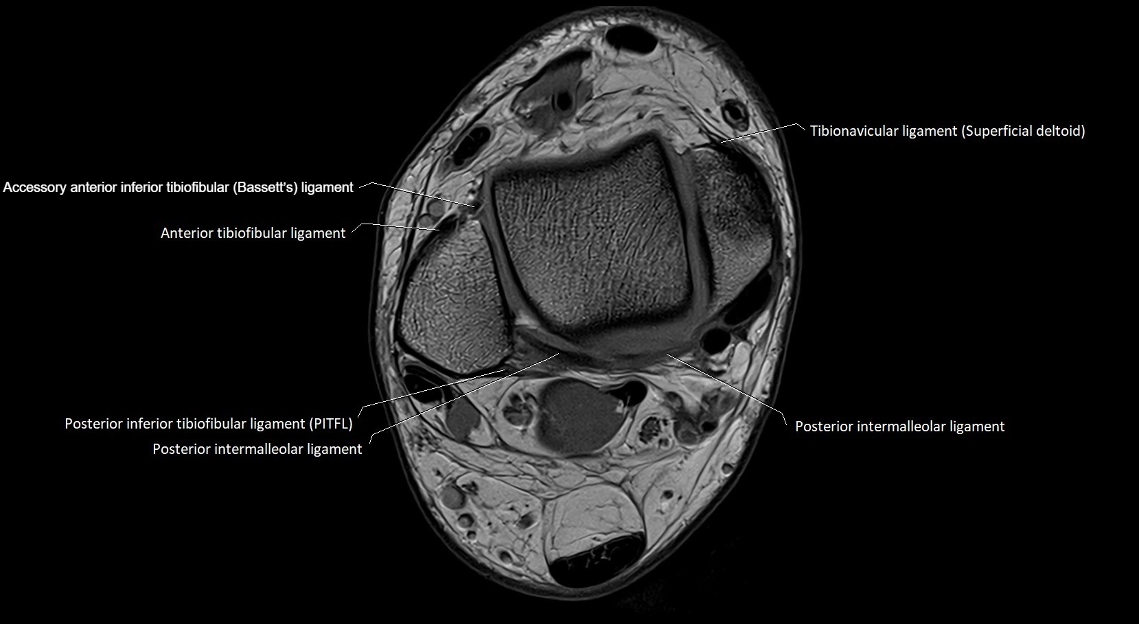 MRI ankle ligaments anatomy axial 3T image 5.webp